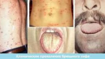 Брюшной Тиф
