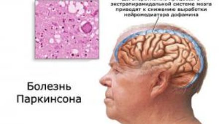 Неврологи обнаружили новое средство против болезни Паркинсона