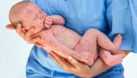 Важные факты о кори, которые должны знать родители