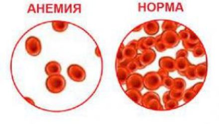 Хроническая анемия