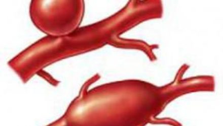 6 простых правил, чтобы избежать смертельной болезни сосудов
