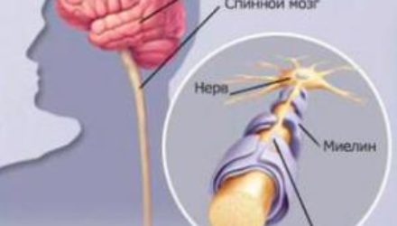 Врачи назвали первые признаки рассеянного склероза