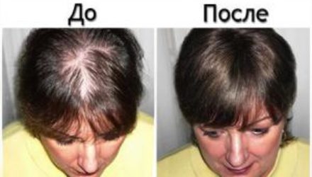 Учёные создали новое средство от облысения