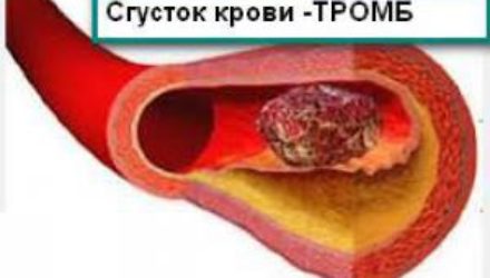 Признаки тромба в сосудах, игнорировать которые чревато смертельными последствиями