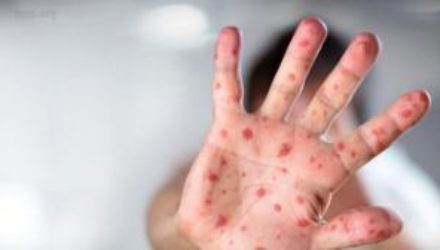 В Мариуполе выявлены первые случаи кори