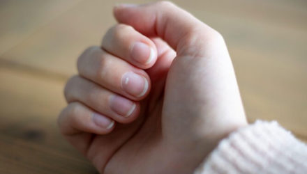 Почему появляются белые пятна на ногтях? И как вообще связаны ногти и здоровье?