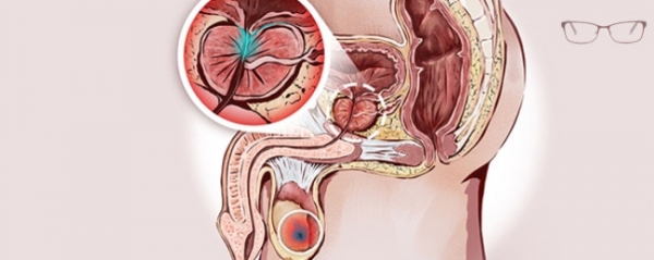 
Простатит и изменение мочевого потока: диагностика и подходы к улучшению 