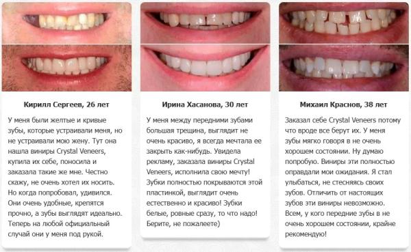 Crystal Veneers виниры для зубов
Crystal Veneers виниры для зубов