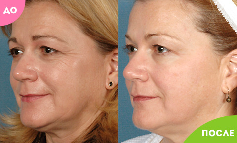 
				Золотая маска CledBel			