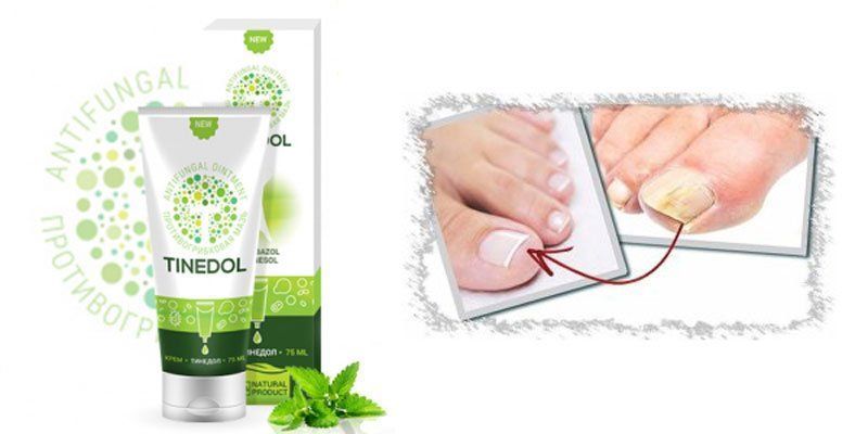Тинедол: Комплексный подход к уходу за стопами при грибковых проявлениях — Фото 3