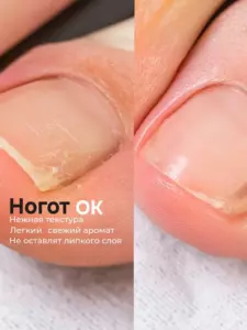 
				Ноготок &mdash; мазь от грибка			